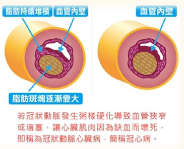 冠心病血管示意圖